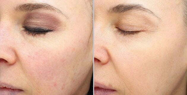 HALO, Beautiful! Check Out Your Latest Option for Laser Resurfacing