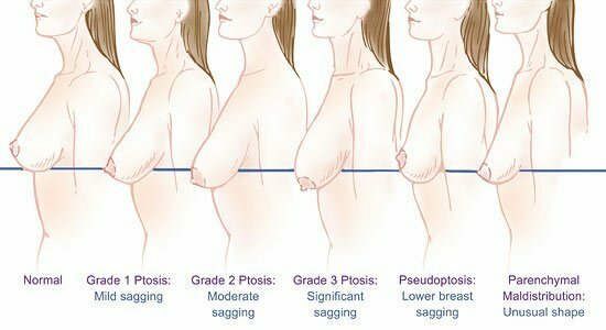 atlanta ga breast lift surgeon Atlanta ga breast lift surgeon