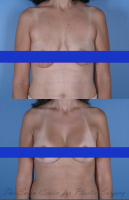 breast lift with breast implants Alpharetta GA