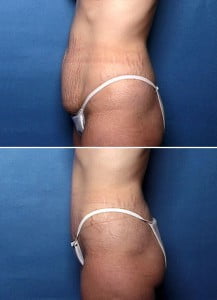 tummy tuck side view Swan Center for Plastic Surgery
