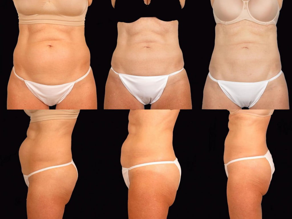 Before, 8 weeks after, 12 weeks after CoolSculpting