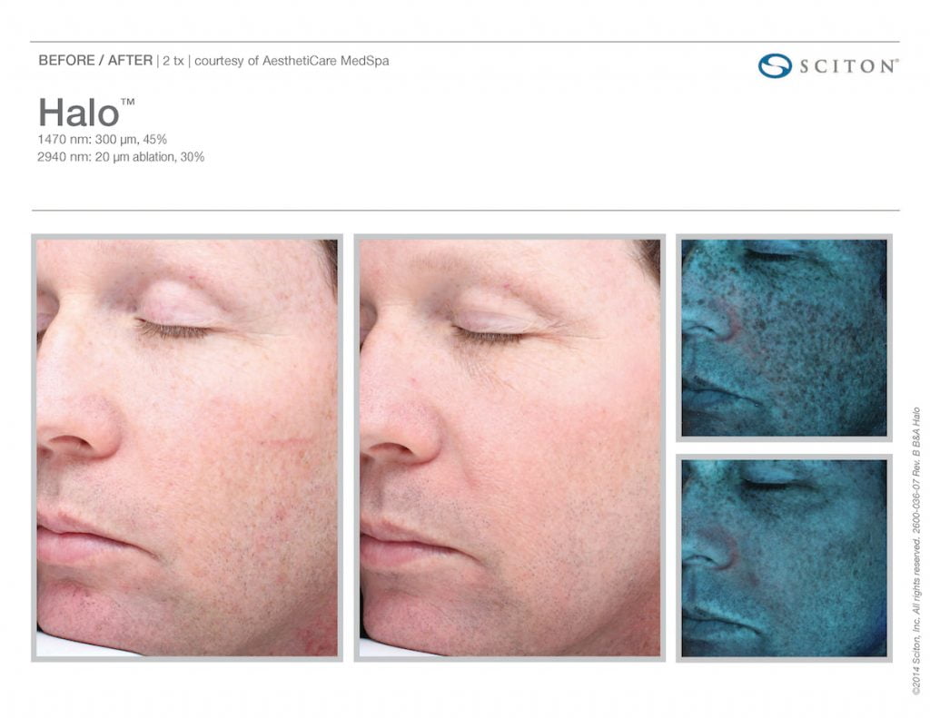 Atlanta laser skin resurfacing for men