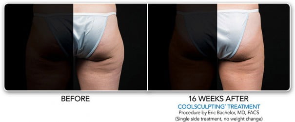 before-after-16weeks-coolsmooth-coolsculpting-605x251