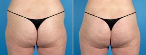 Liposuction & Fat Transfer