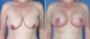 Breast Augmentation with Lift