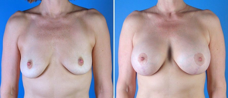 Consider, that breast lift patient photos you With you breast lift patient photos