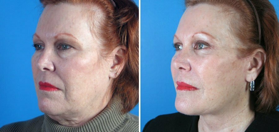 Swan Center Atlanta facelift eyelid lift patient before and after