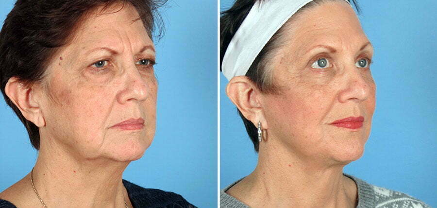 Swan Center in Atlanta patient shown before and after facelift surgery with eyelid lift, and liposuction of the chin and neck