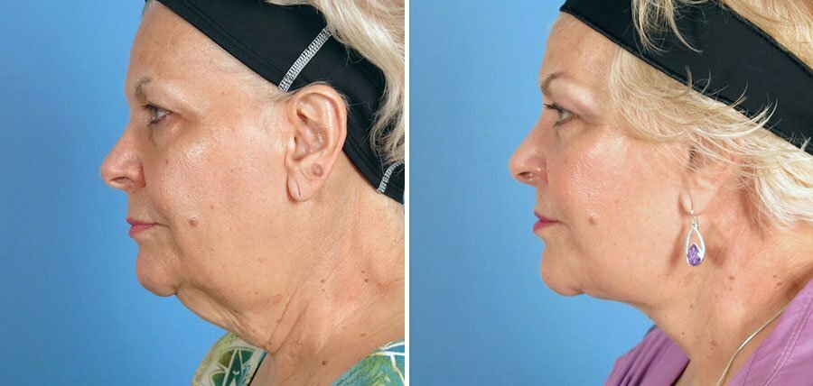 Swan Center patient results shown before and after facial rejuvenation surgery