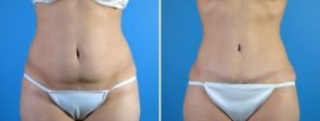 Tummy Tuck & Liposuction