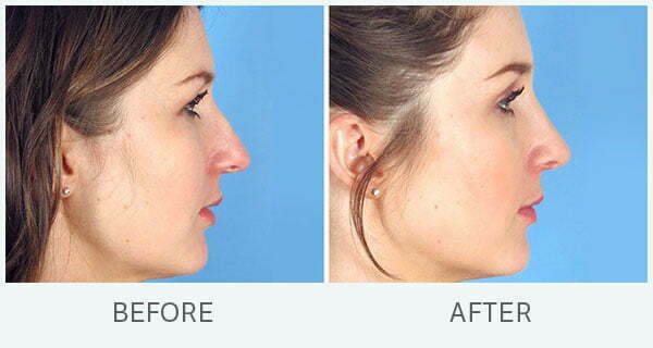 swan-center-rhinoplasty-results-01