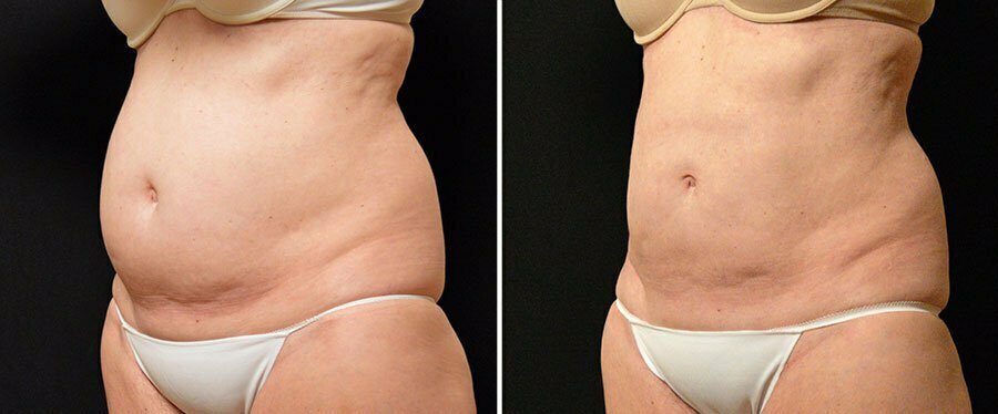 Atlanta CoolSculpting results at Swan Center