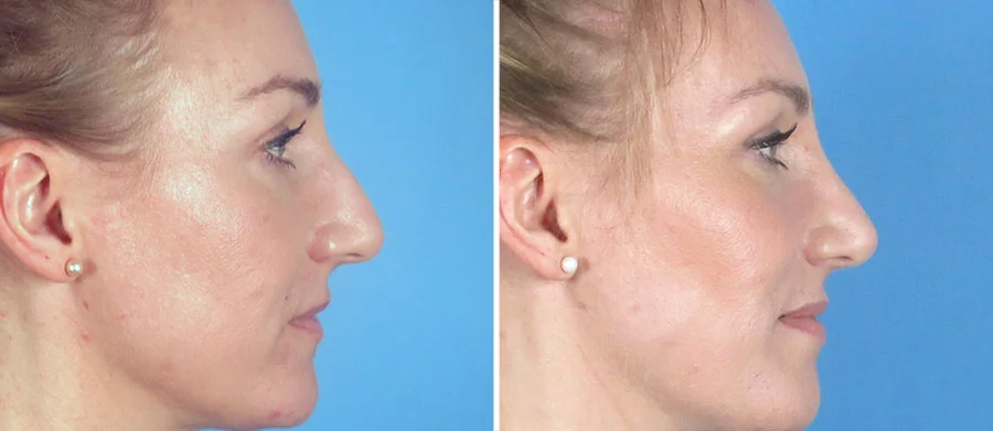 Rhinoplasty Surgery Costs Atlanta Georgia
