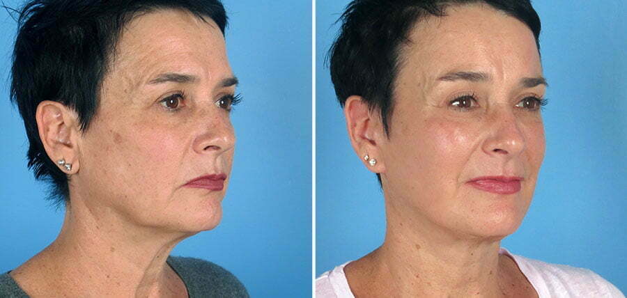 Facelift Atlanta. Before and after patient results.