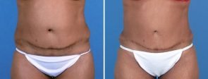 fat-transfer-buttocks-liposuction-19760a-swan