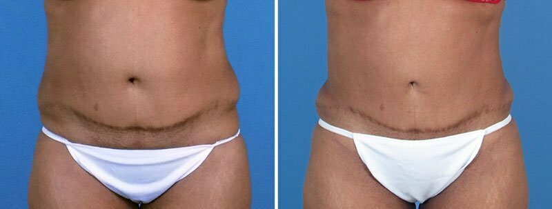 fat-transfer-buttocks-liposuction-19760a-swan