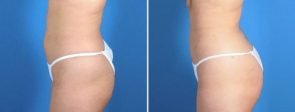 fat-transfer-buttocks-liposutcion-19759-c-swan