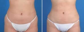 fat-transfer-buttocks-liposutcion-19759a-swan
