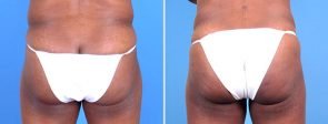 Fat Transfer with Liposuction and Tummy Tuck