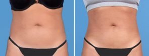 fat-transfer-buttocks-liposuction-19836a-swan