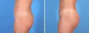 fat-transfer-buttocks-liposuction-19836c-swan