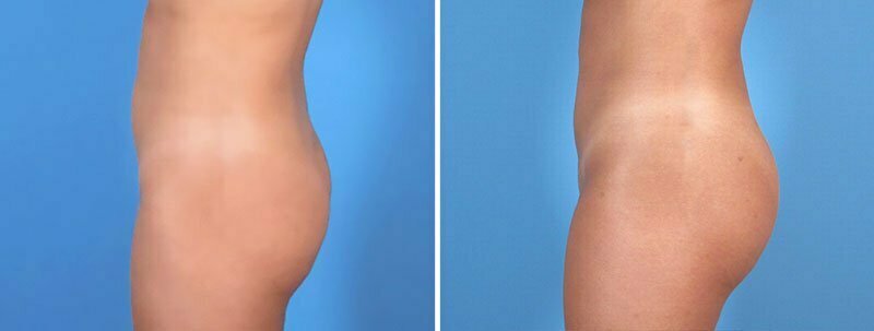 Real patient shown before and after fat transfer with liposuction