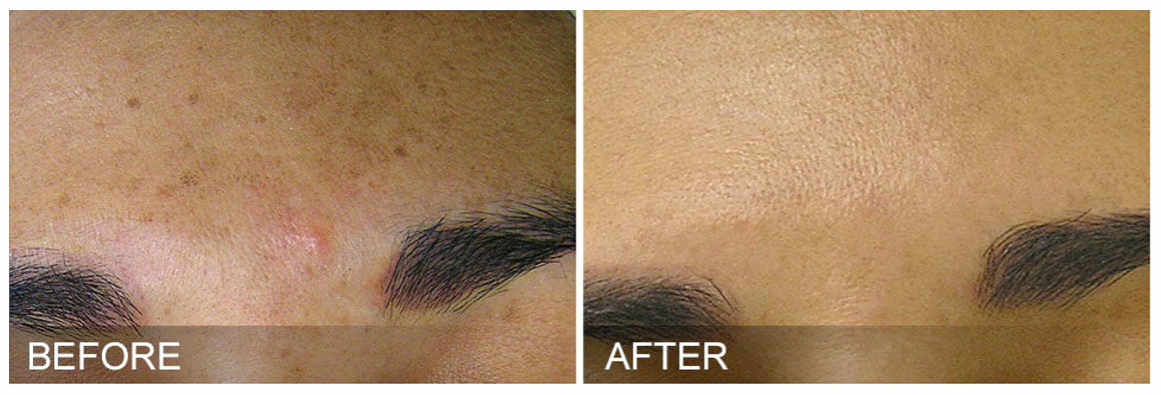 HydraFacial Before and After