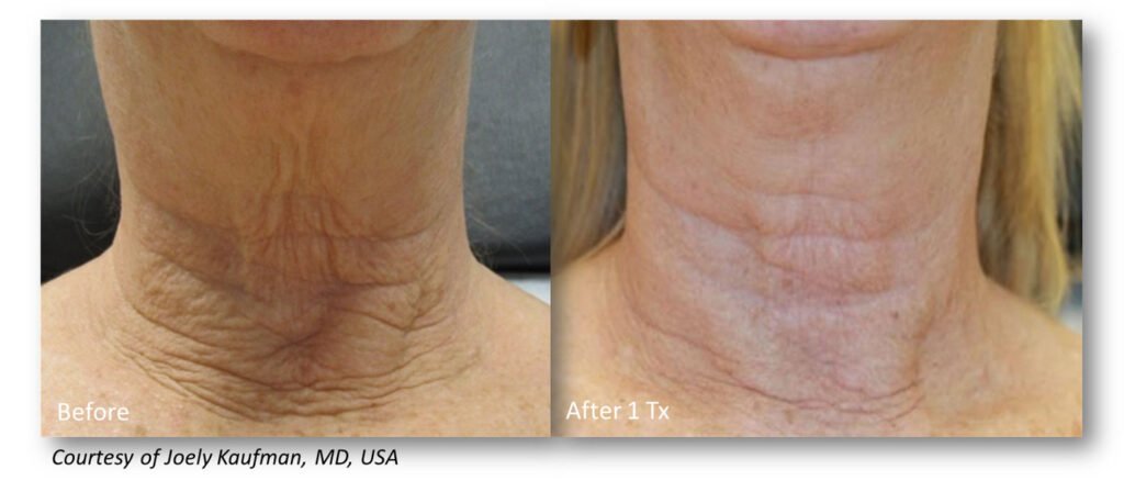 RF Microneedling Before and After Patient Results