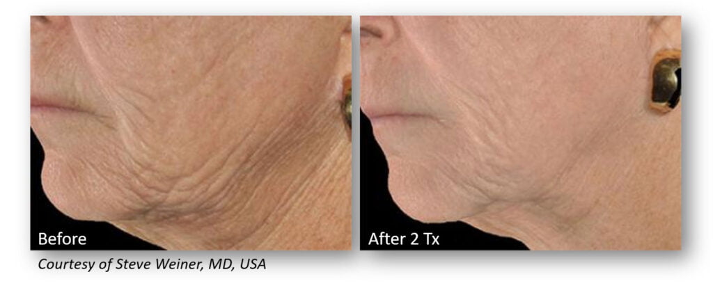 RF Microneedling Before and After Patient Results