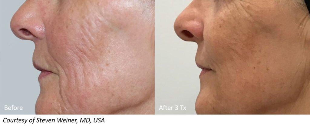 RF Microneedling Before and After Patient Results