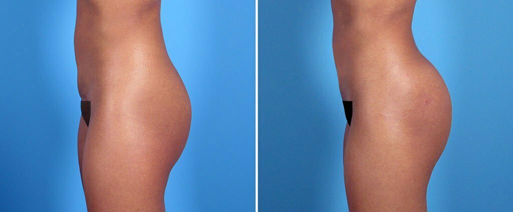 Before and after Sculptra butt lift