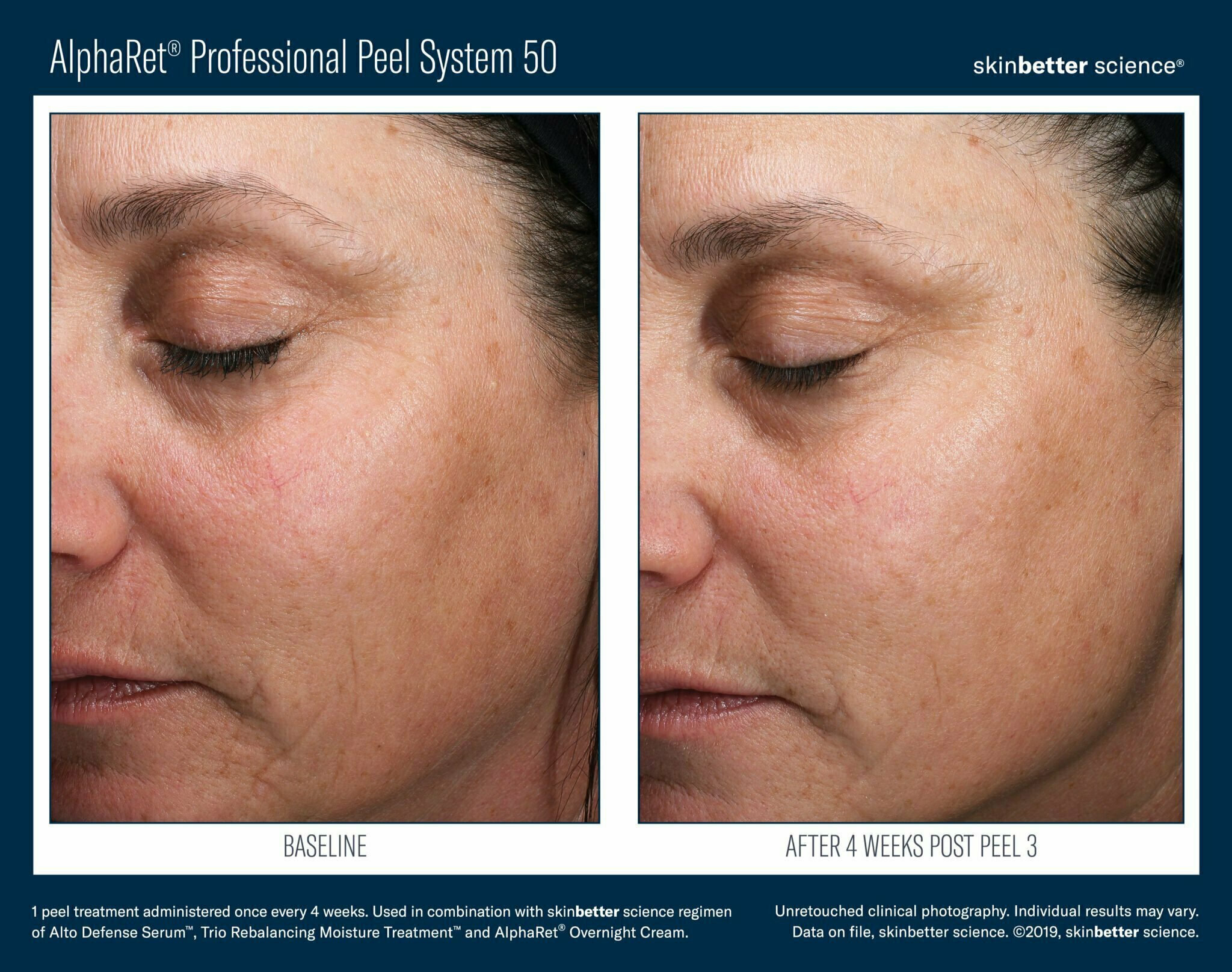Chemical Peels Atlanta Swan Center For Plastic Surgery chemical-peels-atlanta-swan-center-for-plastic-surgery