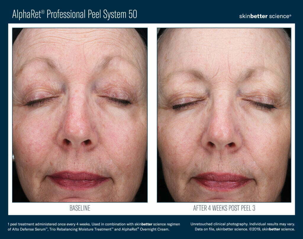 AlphaRet Professional Peel System 50 Before & After 1