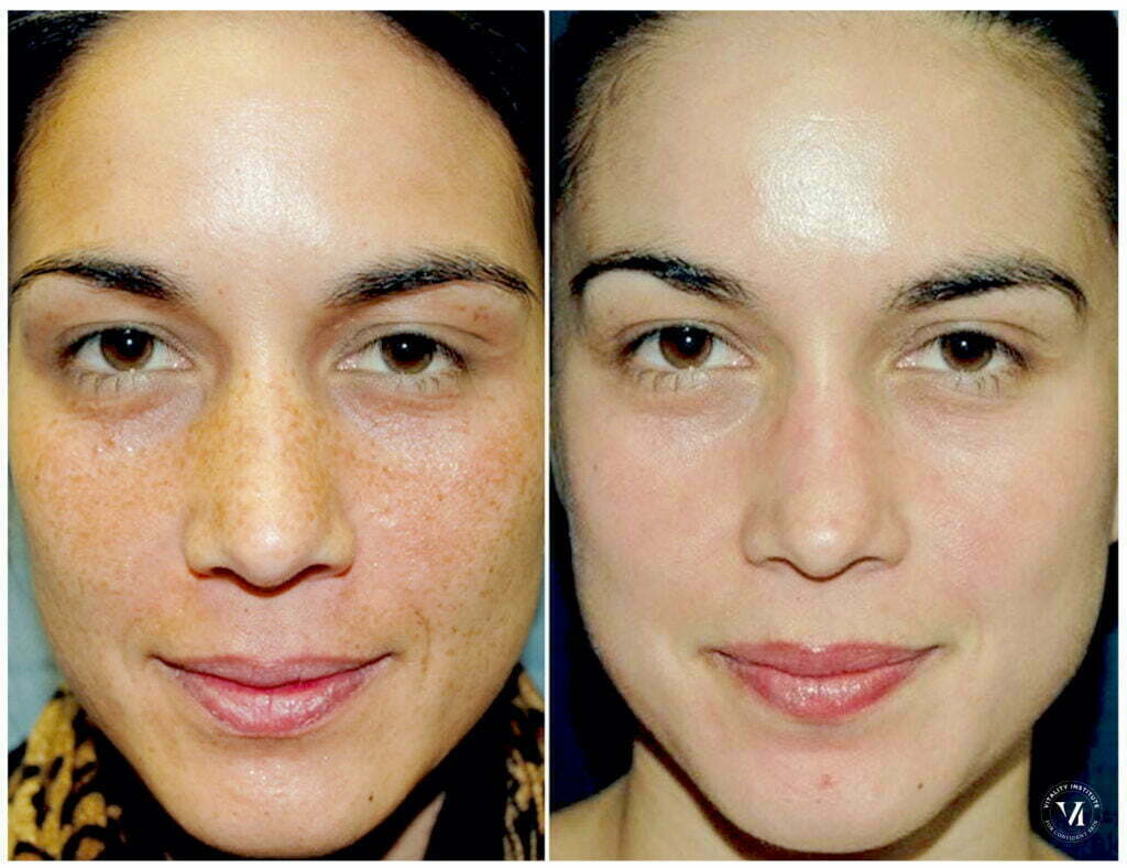 VI Peel Chemical Peel before and after