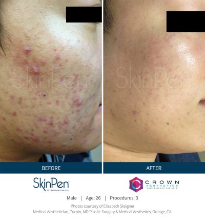 SkinPen Microneedling before and after