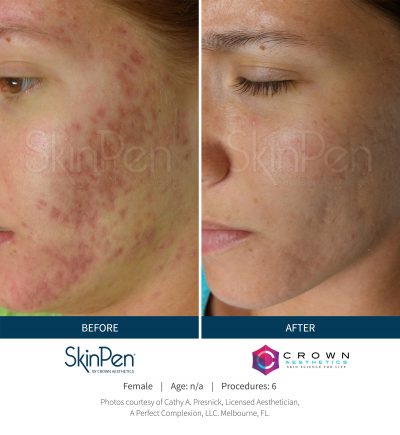 Before and After SkinPen Microneedling treatment