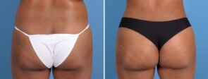 Fat Transfer to Buttocks and Liposuction