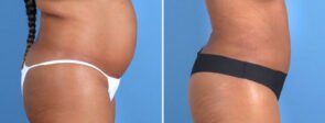 liposuction-butt-lift-24076c-swan