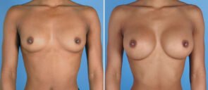 breast-augmentation-24142a-swan