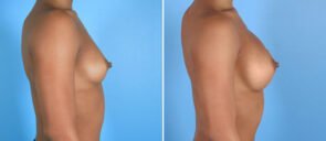 breast-augmentation-24142c-swan