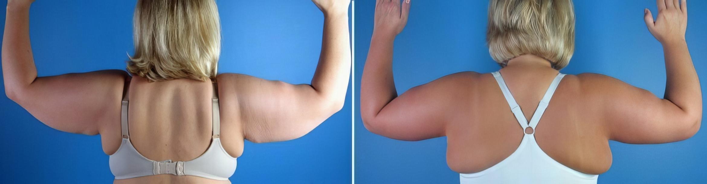Arm Lift Before & After Case 17350