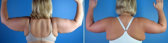 Arm Lift Before & After Case 17350
