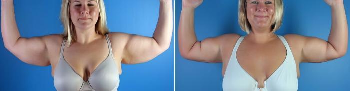 Arm Lift Before & After Case 17350