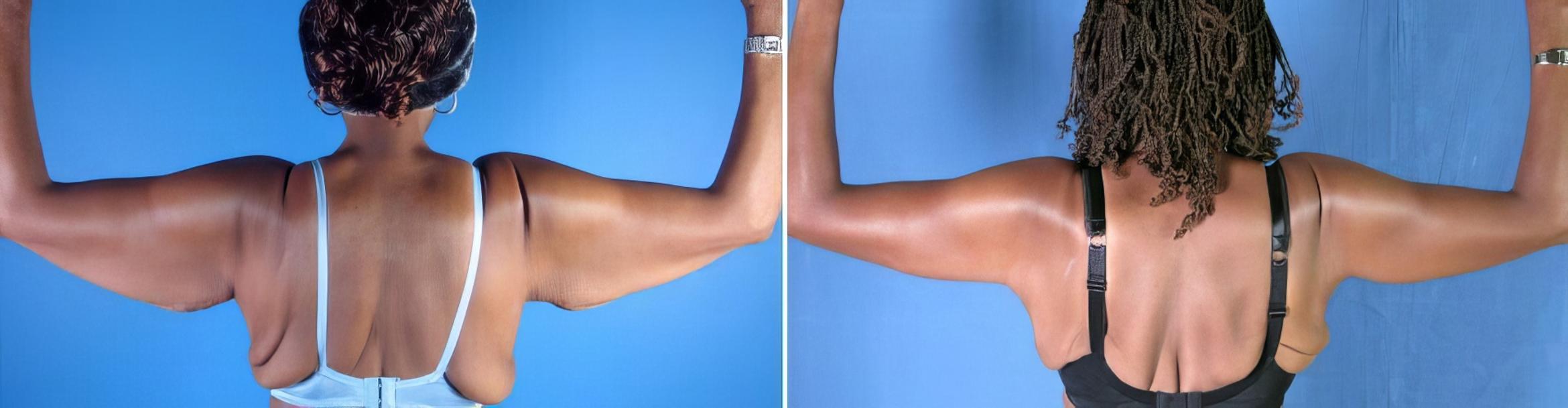 Arm Lift Before & After Case 17792