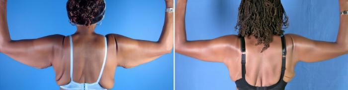 Arm Lift Before & After Case 17792