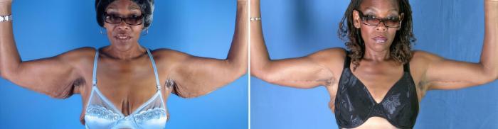 Arm Lift Before & After Case 17792