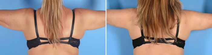 Arm Lift Before & After Case 19391