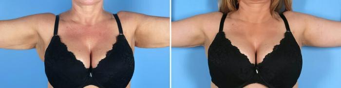 Arm Lift Before & After Case 19391