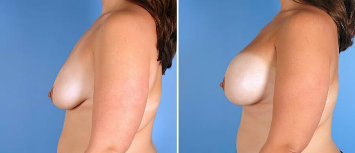 Breast Asymmetry Before & After Case 18198