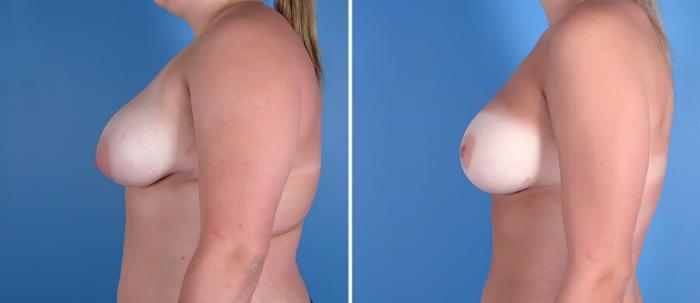 Breast Asymmetry Before & After Case 18201